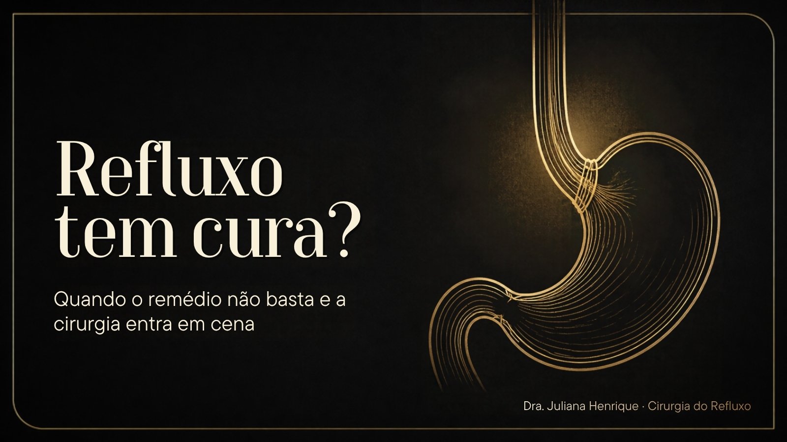 Ilustração do esôfago e do estômago com a válvula antirrefluxo em destaque: refluxo tem cura?